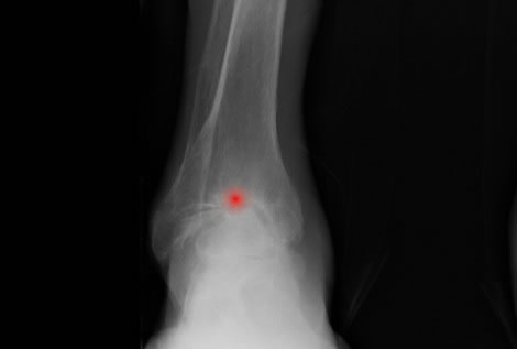 Patología Degenerativa: Artrosis