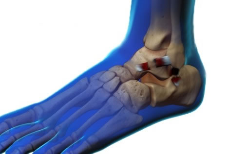 La inestabilidad de tobillo