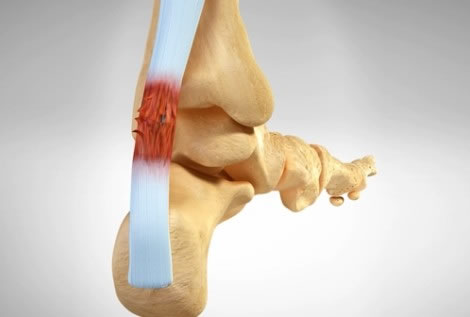 Patología Tendinosa